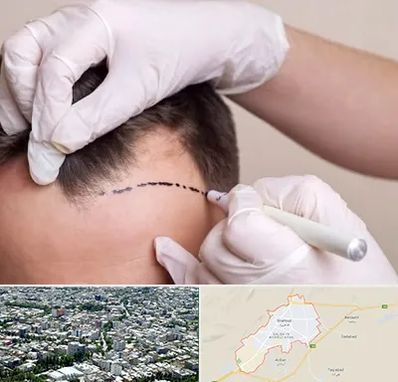 کاشت مو به روش SUT در شاهرود