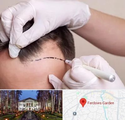 کاشت مو به روش SUT در باغ فردوس