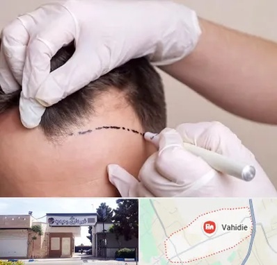 کاشت مو به روش SUT در وحیدیه شهریار