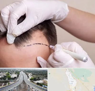 کاشت مو به روش SUT در اندیمشک