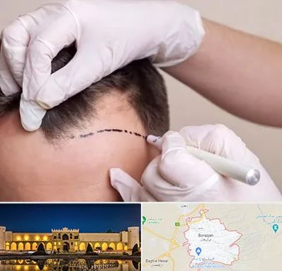 کاشت مو به روش SUT در برازجان