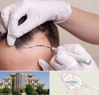 کاشت مو به روش SUT در دهدشت