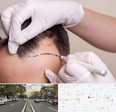 کاشت مو به روش SUT در دولت 