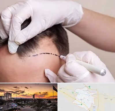 کاشت مو به روش SUT در قوچان