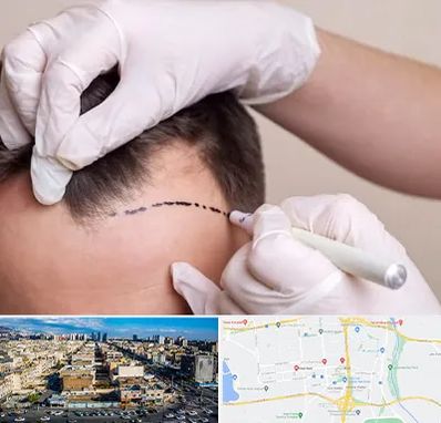 کاشت مو به روش SUT در شهرک راه آهن