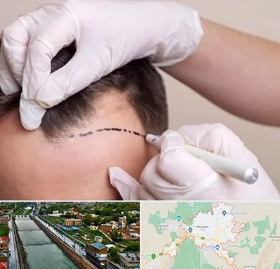 کاشت مو به روش SUT در مراغه