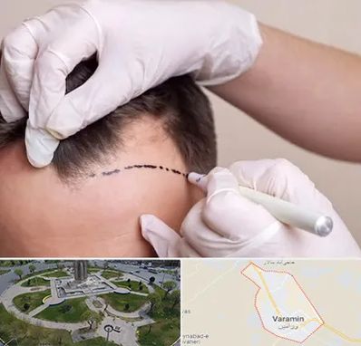 کاشت مو به روش SUT در ورامین