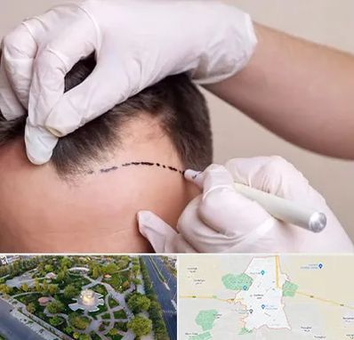 کاشت مو به روش SUT در کاشمر