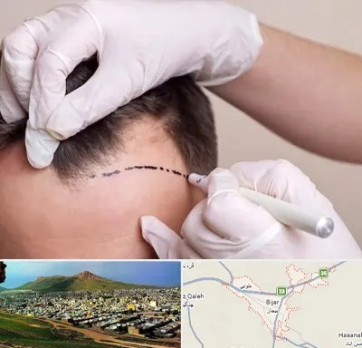 کاشت مو به روش SUT در بیجار