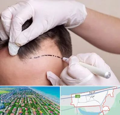 کاشت مو به روش SUT در نور