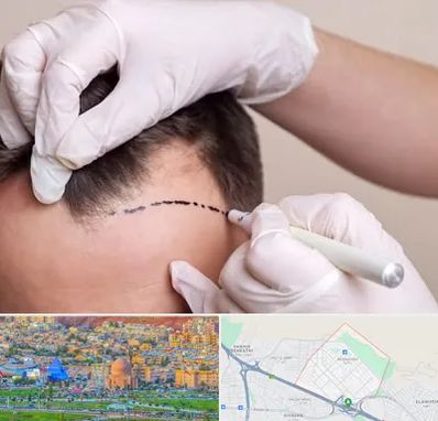 کاشت مو به روش SUT در رشدیه تبریز