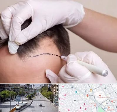 کاشت مو به روش SUT در خیابان زند شیراز