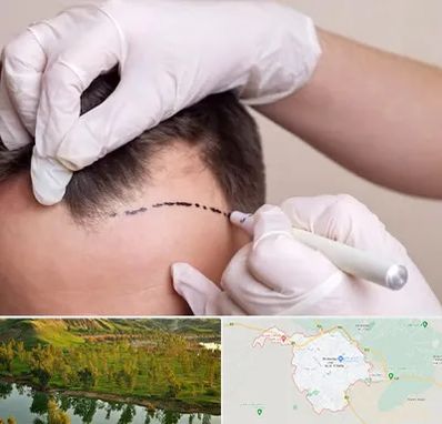 کاشت مو به روش SUT در بهبهان