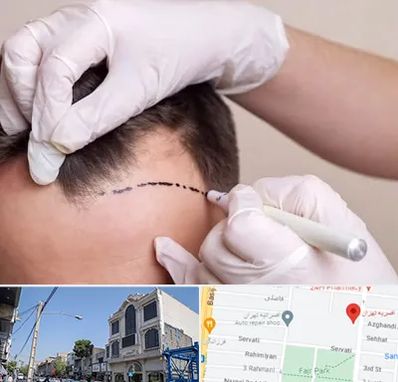 کاشت مو به روش SUT در افسریه 