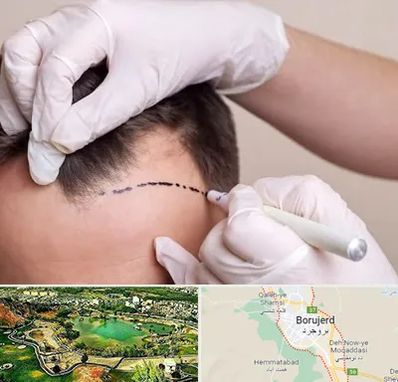 کاشت مو به روش SUT در بروجرد