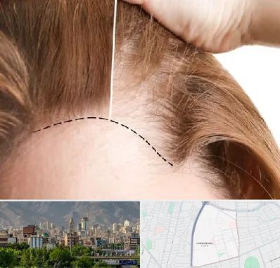 کاشت مو برای خانمها در جمشیدیه