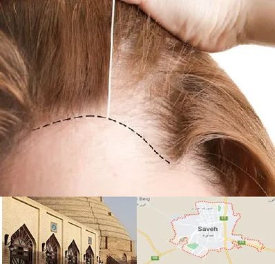 کاشت مو برای خانمها در ساوه