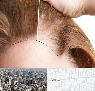 کاشت مو برای خانمها در جیحون