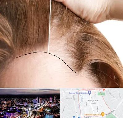 کاشت مو برای خانمها در گلسار رشت 