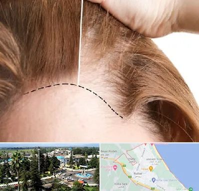 کاشت مو برای خانمها در رودسر