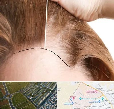 کاشت مو برای خانمها در الهیه مشهد