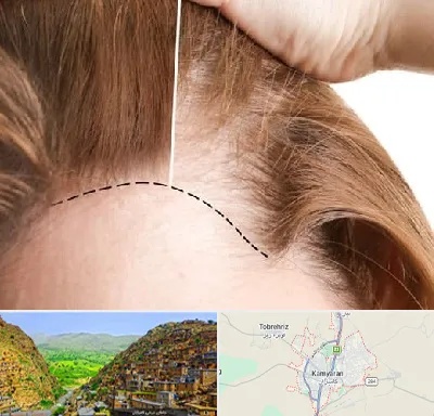 کاشت مو برای خانمها در کامیاران