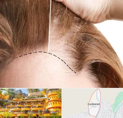 کاشت مو برای خانمها در دربند