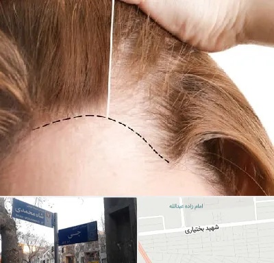 کاشت مو برای خانمها در سی متری جی