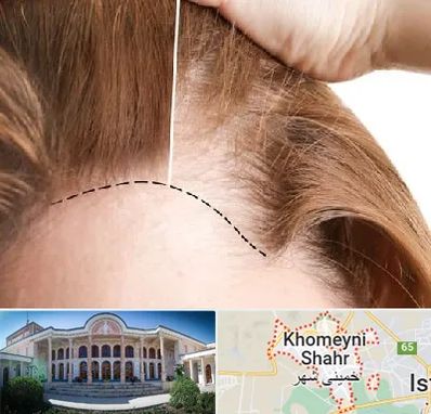 کاشت مو برای خانمها در خمینی شهر