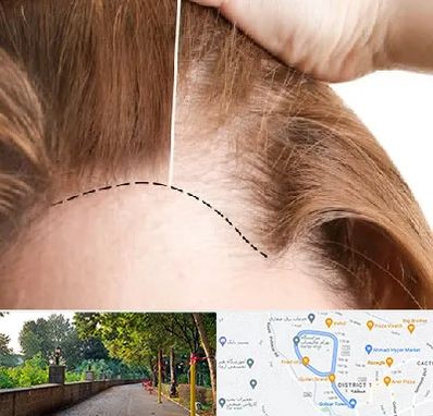 کاشت مو برای خانمها در بلوار گیلان رشت