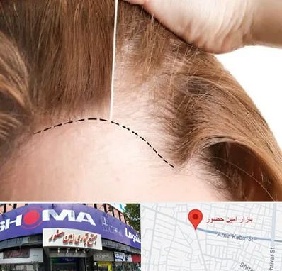 کاشت مو برای خانمها در امین حضور