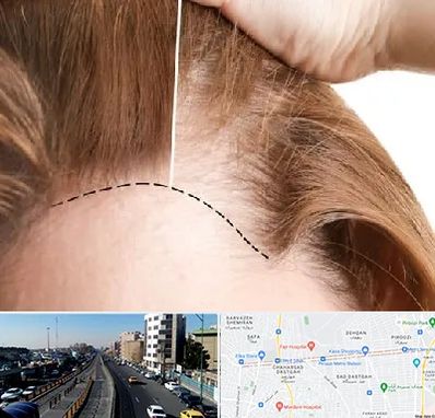 کاشت مو برای خانمها در پیروزی 