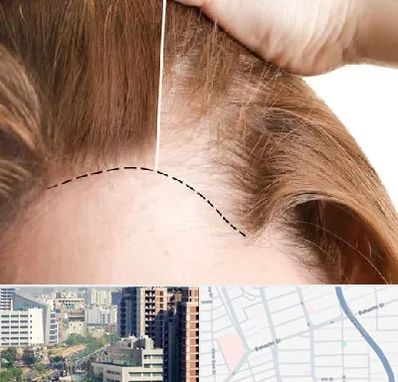 کاشت مو برای خانمها در خیابان بهشتی