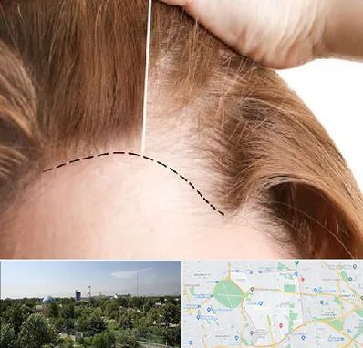 کاشت مو برای خانمها در منطقه 16 تهران 