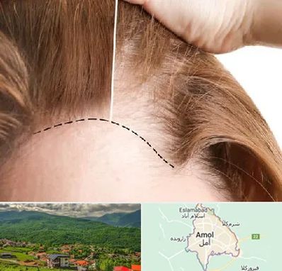 کاشت مو برای خانمها در آمل