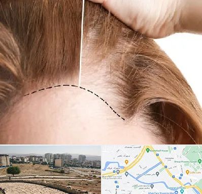 کاشت مو برای خانمها در کوی وحدت شیراز