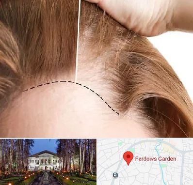 کاشت مو برای خانمها در باغ فردوس