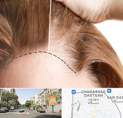 کاشت مو برای خانمها در چهارصد دستگاه 
