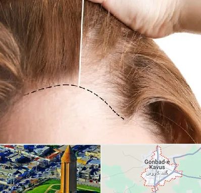 کاشت مو برای خانمها در گنبد کاووس