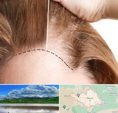 کاشت مو برای خانمها در مرند