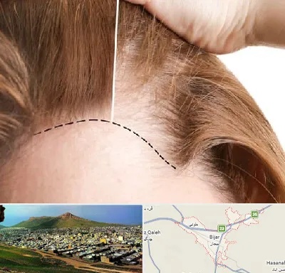 کاشت مو برای خانمها در بیجار