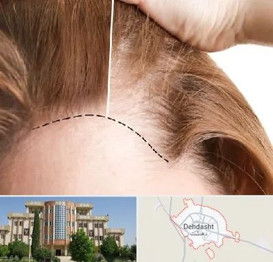 کاشت مو برای خانمها در دهدشت