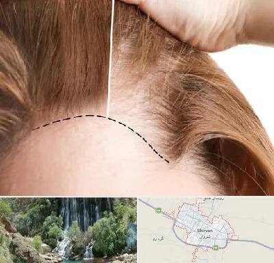 کاشت مو برای خانمها در شیروان