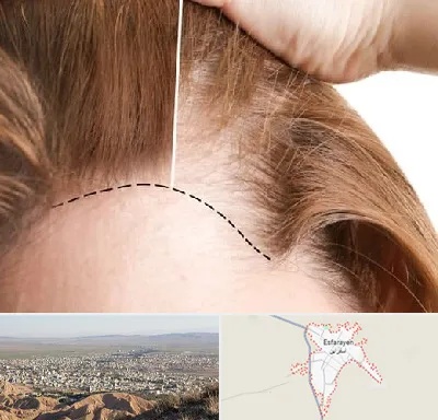 کاشت مو برای خانمها در اسفراین