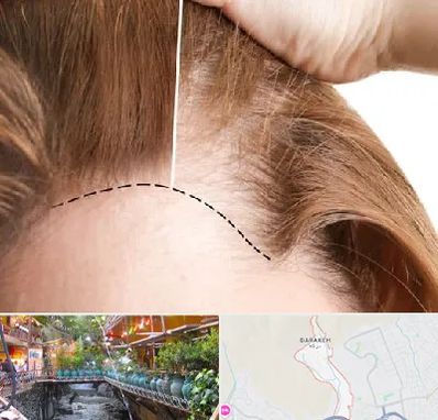 کاشت مو برای خانمها در درکه