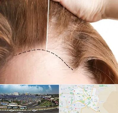 کاشت مو برای خانمها در منطقه 15 تهران 