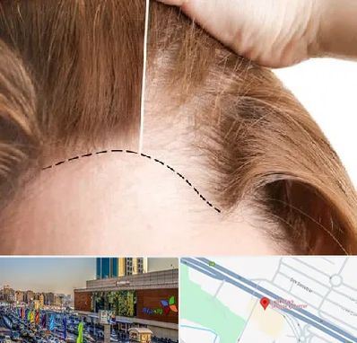 کاشت مو برای خانمها در لاله پارک تبریز