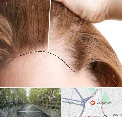 کاشت مو برای خانمها در زرگنده