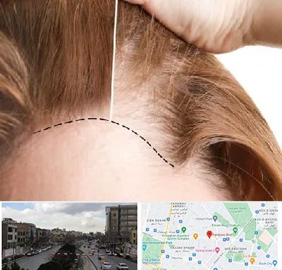 کاشت مو برای خانمها در بلوار فردوسی مشهد 