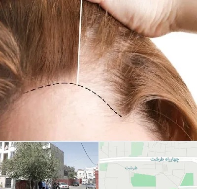 کاشت مو برای خانمها در طرشت